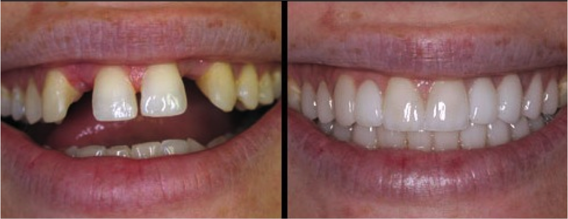 A fixed bridge replaces one or more teeth by placing crowns on the teeth either side of the gap, and attaching artificial teeth to them. The "bridge" is then cemented into place. 