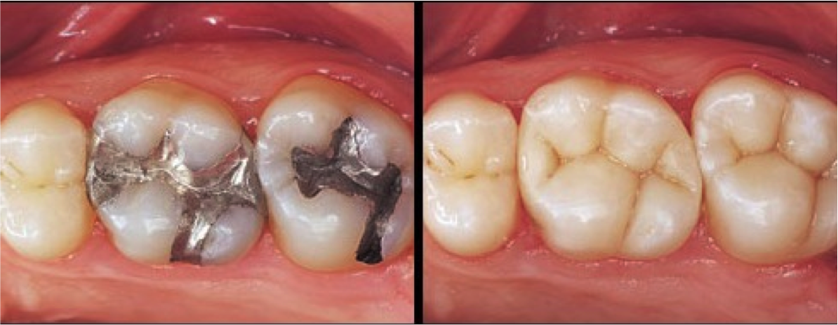 Composite fillings are tooth colored fillings used to repair a tooth that is affected by decay. Existing fillings sometimes need to be replaced due to wear, chipping, or cracking. Many people use this opportunity to replace their silver amalgam fillings with natural, tooth-colored composites. 