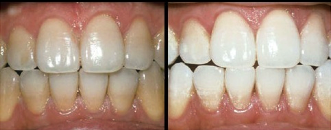 Teeth whitening (or bleaching) is a simple, non-invasive dental treatment used to change the color of natural tooth enamel.  It's ideal for people who have healthy, unrestored teeth and gums. 