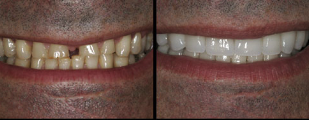 Veneers are thin, custom-made shells that cover the front surface of teeth to change their color, shape, size or length, veneers can be made from porcelain or resin composite. Veneers offer a conservative approach to changing a tooth's color or shape compared to crowns, but the process is not reversible.