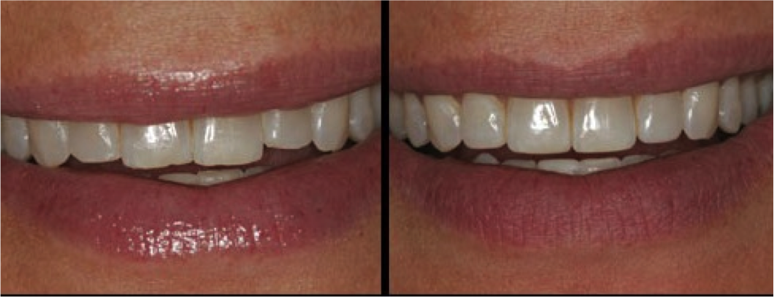 Enamel contouring is a quick and painless process of shaping natural teeth to improve their appearance. It is generally used to correct small imperfections such as uneven teeth or teeth that are slightly overcrowded. Results can be seen immediately. 